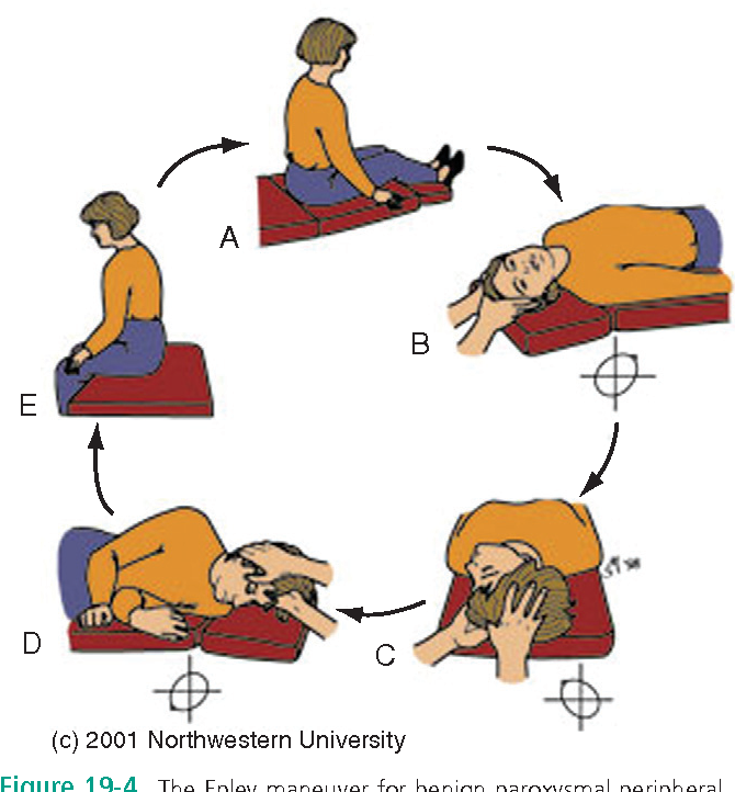 printable vertigo exercises pictures